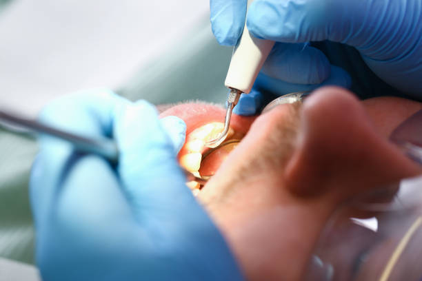 Best Dentist for Tooth Abscess  in Portland, TX