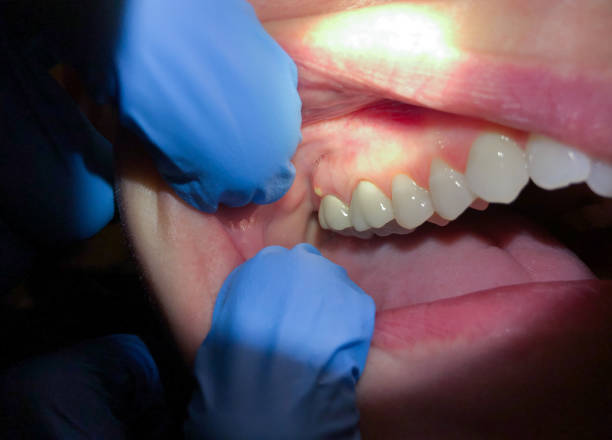 Best Dentist for Tooth Abscess  in Portland, TX